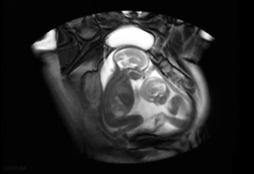 7. Twins interact while in the womb