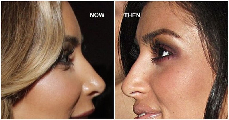 13. Kim Kardashian - Nose