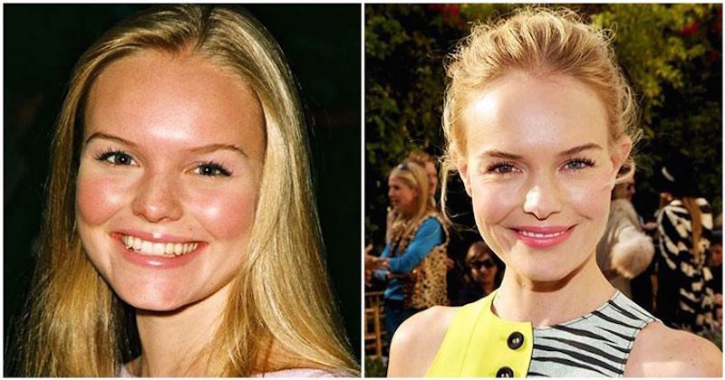 7. Kate Bosworth - Facial Plastic Surgery