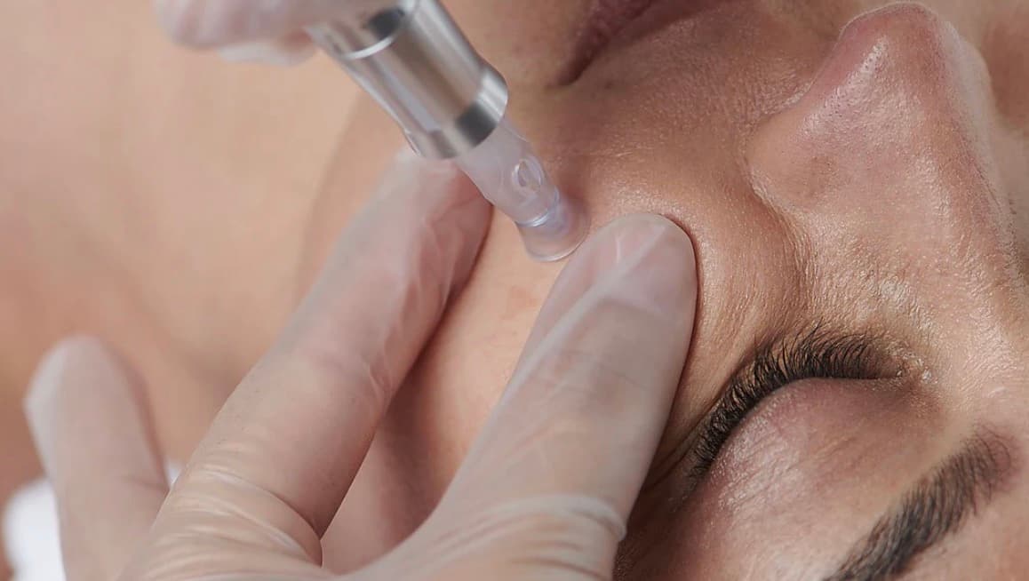 Nurturing Youthful Skin With Microneedling