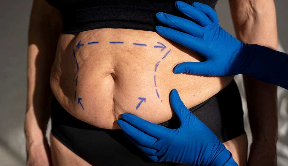 Unlocking the Door: How to Meet the Standards for Abdominoplasty