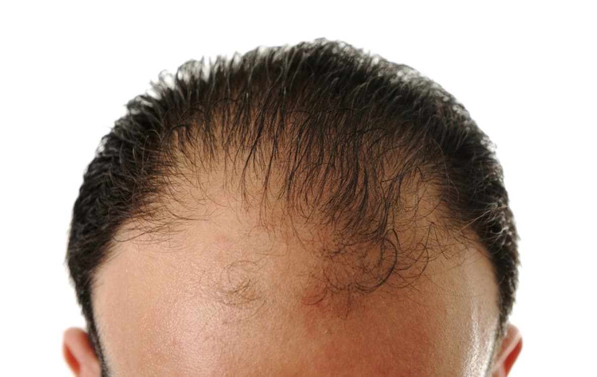 Common Causes of Hair Loss and How to Deal With It