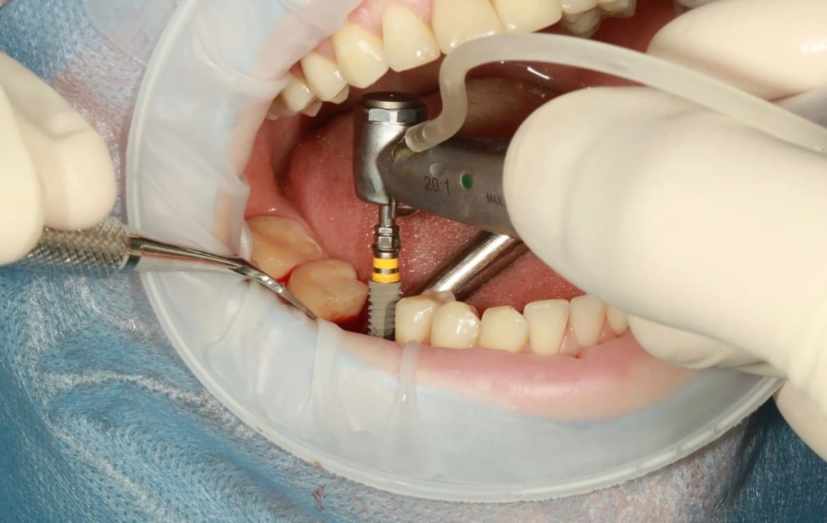 Dental Implants: Why They’re Worth the Investment