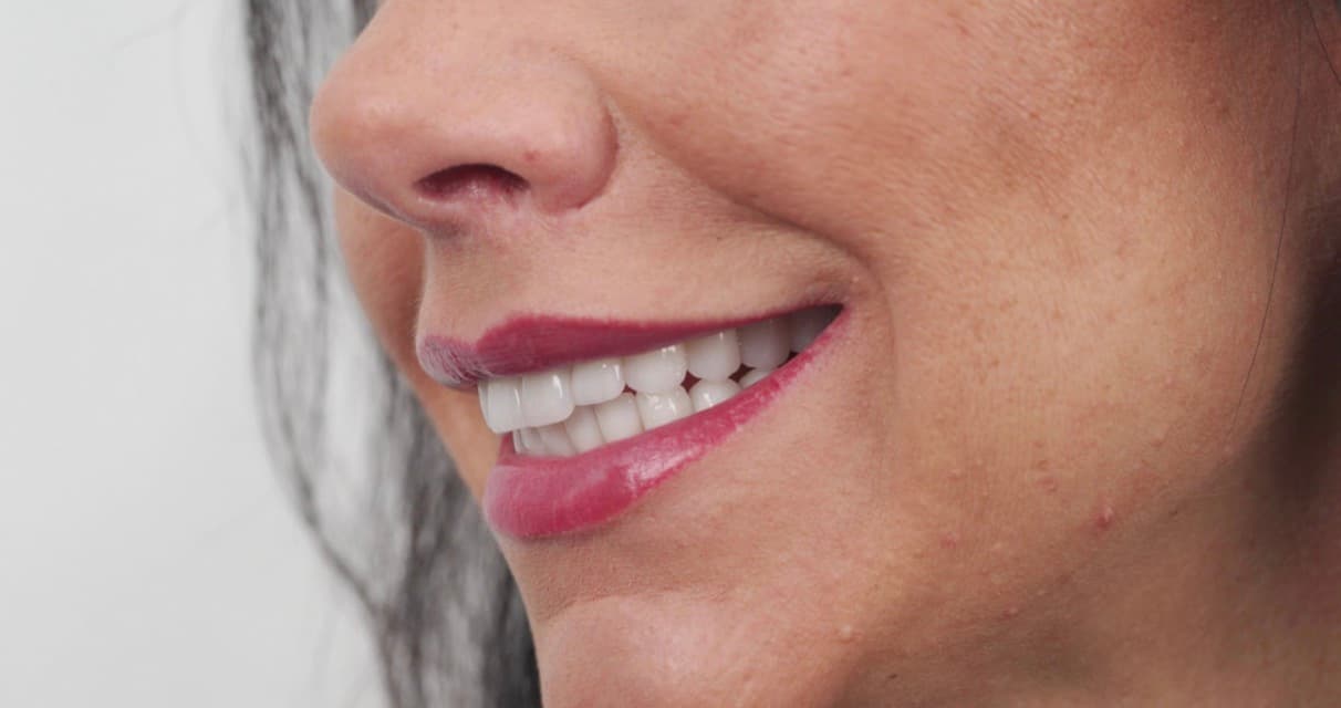 A Beginner’s Guide to Veneers