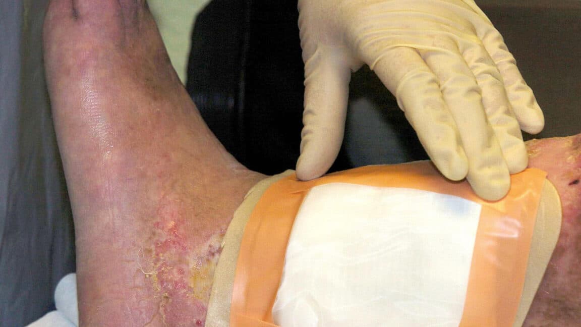 FDA Clears Second Fly Species for Maggot Wound Therapy