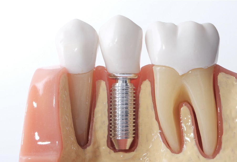 What Are Dental Implants? Everything You Need To Know