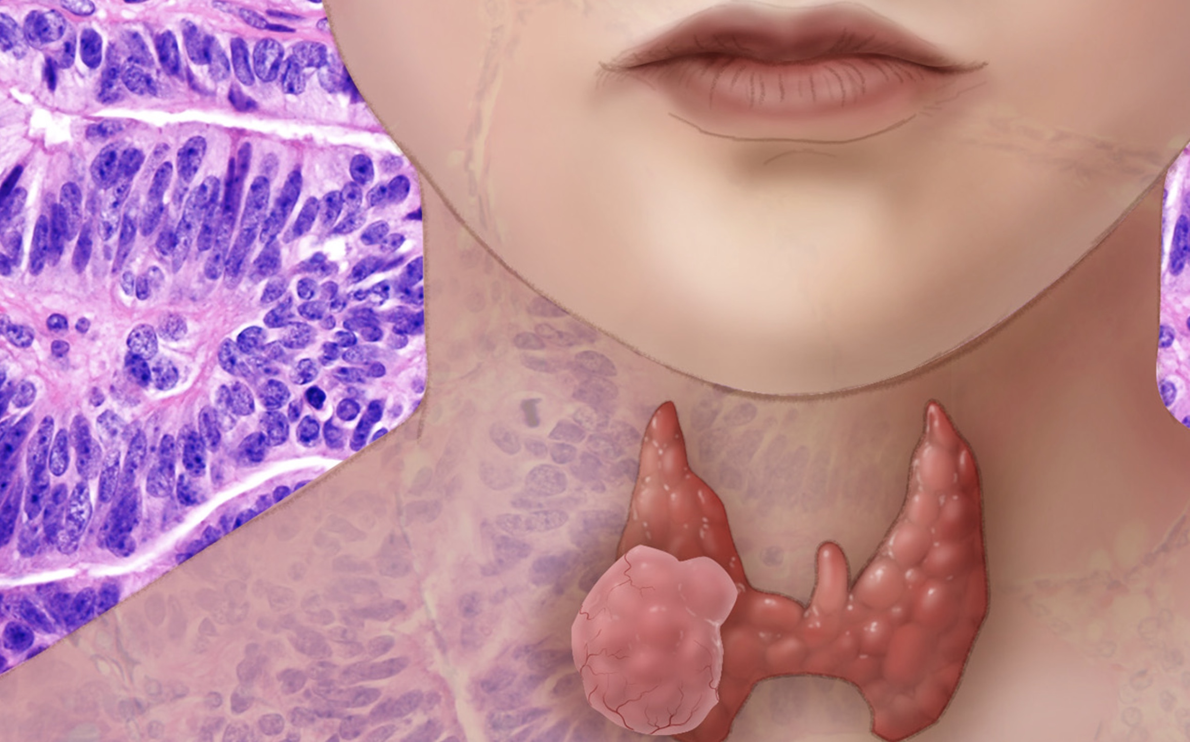 6 Types of Cancer on the Rise