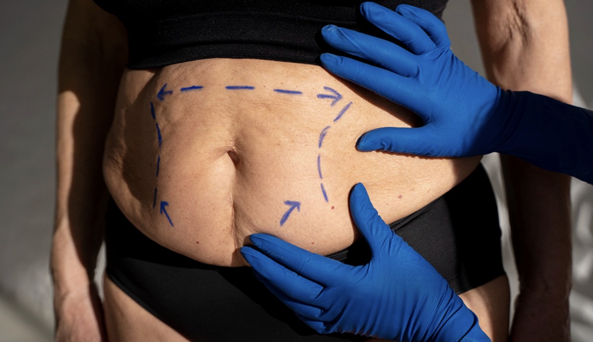 Unlocking the Door: How to Meet the Standards for Abdominoplasty
