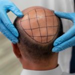 hair, hair care, hair transplant, hair restoration, hair style, hair growth, hair problem, hair care, hair transplant, hair transplant, hair transplant, hair transplant, hair transplant